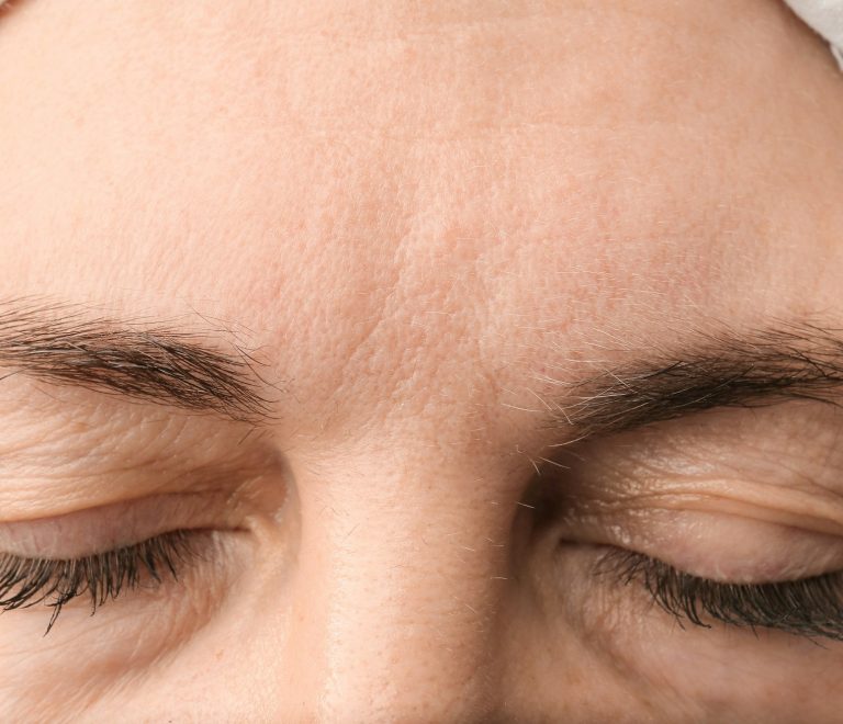 Female forehead with wrinkles