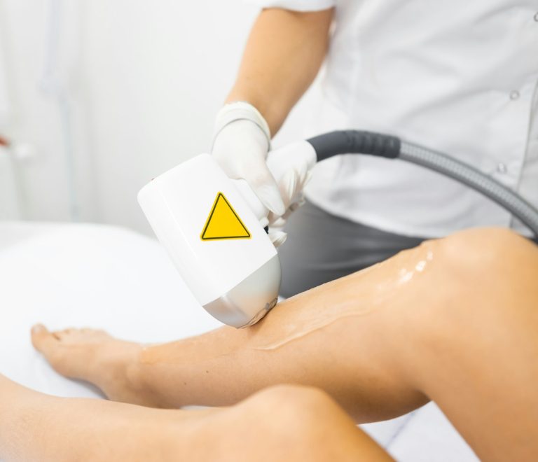 Laser hair removal of female legs close up