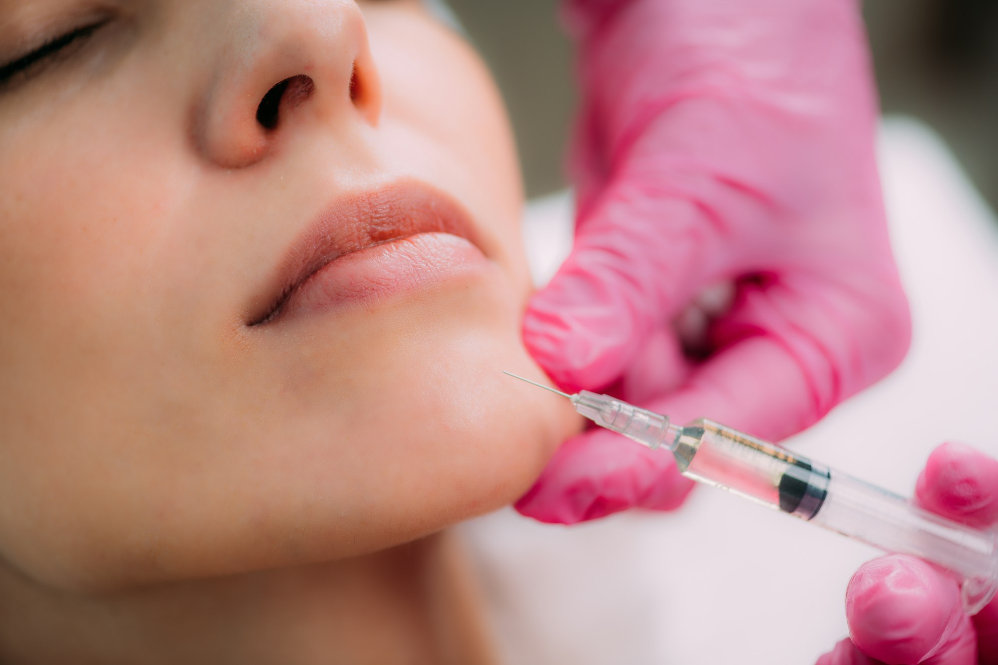 Dermal Filler Injection for Chin